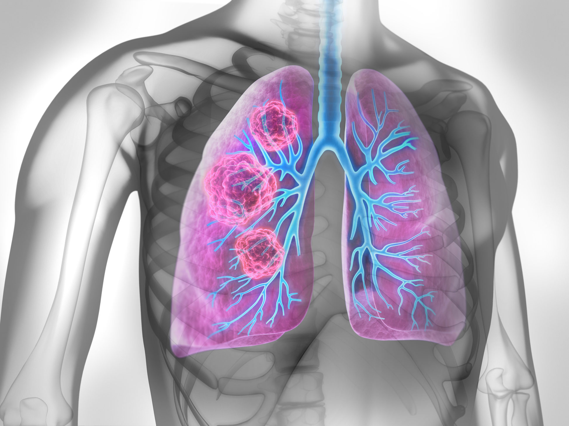 Small Cell Lung Cancer Sclc Bjmo