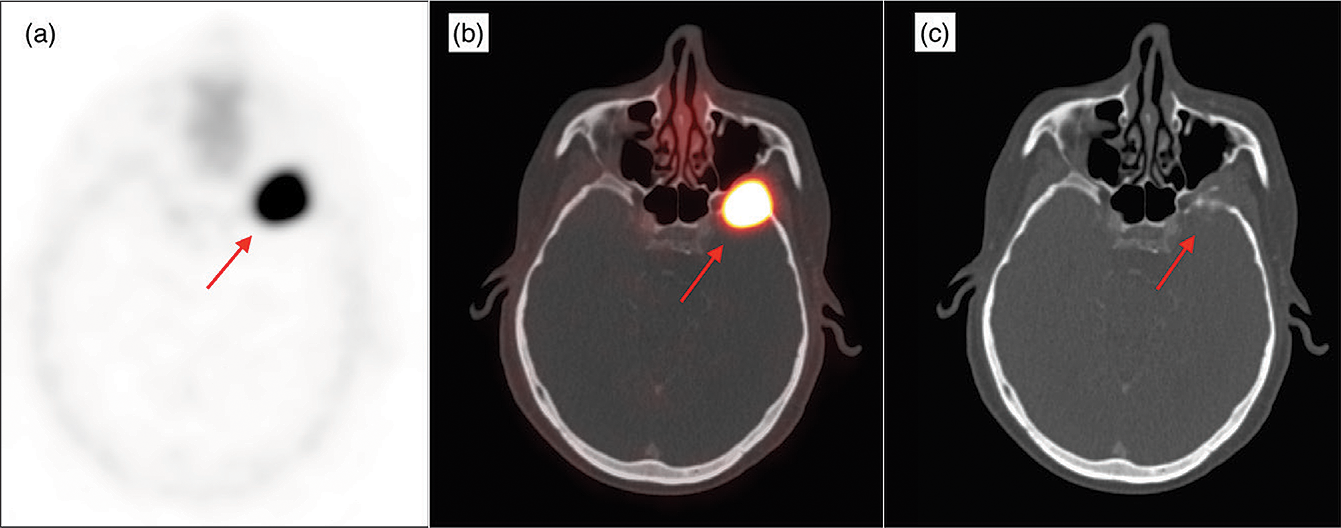 Radiosurgery Brain Tumor Side Effects at Diane Godsey blog